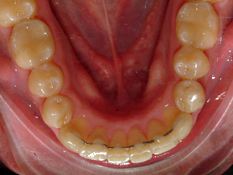 Lower Teeth Retention