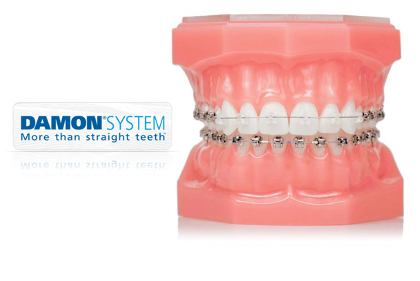 Aparatos ortodoncia Sistema Damon