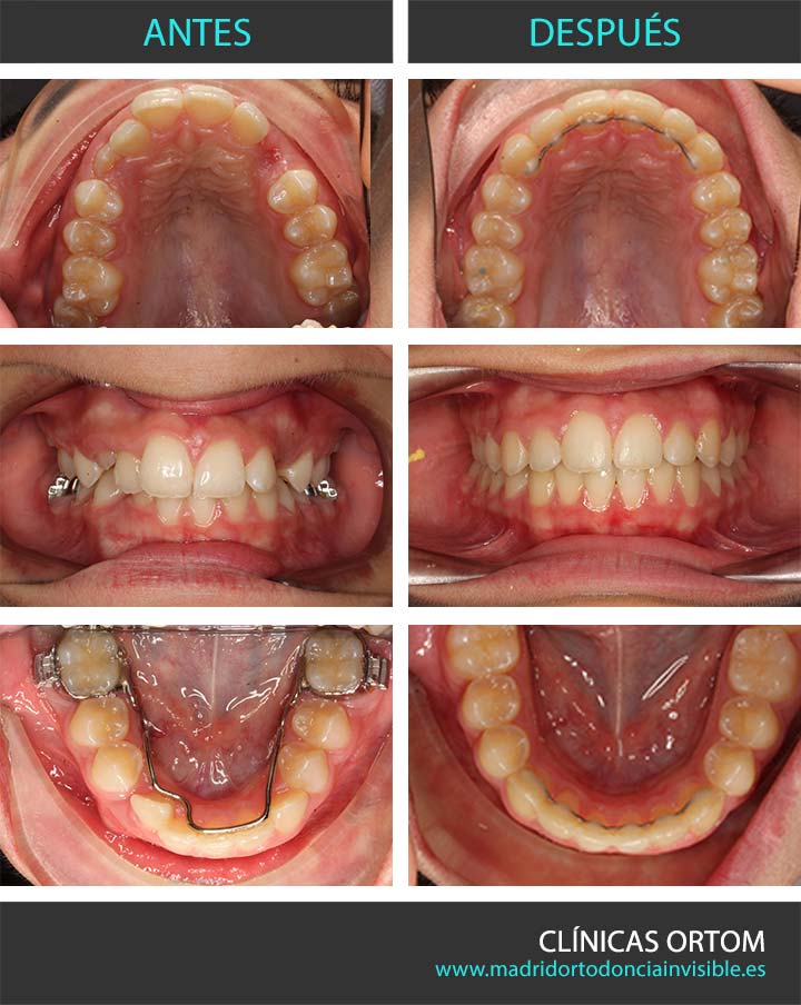 Ortodoncia infantil damon Q