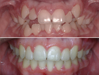caso ortodoncia infantil madrid ortom 03