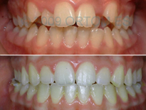 caso ortodoncia infantil madrid ortom 09