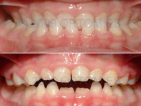 caso ortodoncia infantil madrid ortom 11