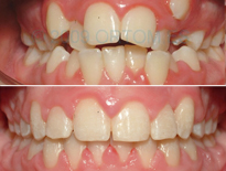 caso ortodoncia infantil madrid ortom 12