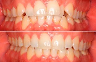 Estética dental con Invisalign