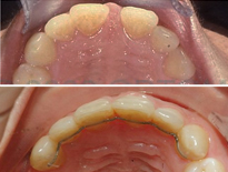 casos ortodoncia clinicas ortom madrid 02