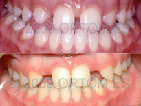 casos ortodoncia clinicas ortom madrid 04