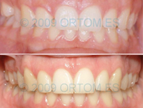 casos ortodoncia clinicas ortom madrid 05