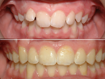 casos ortodoncia clinicas ortom madrid 06