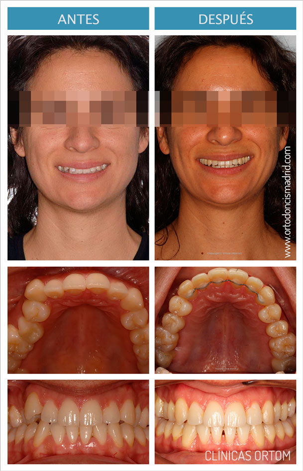 Ortodoncia Invisalign para apiñamiento dentario