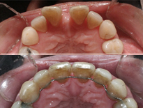 ortodoncia adultos ortom madrid 17
