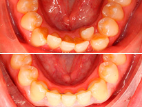 ortodonciaapinamientoclase3invisalign