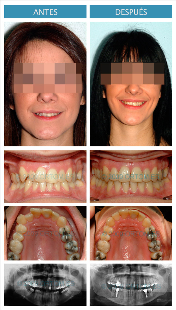 Caso de falta de dientes tratado con implantes