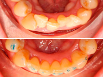 ortodonciainvisalignapinamientosevero