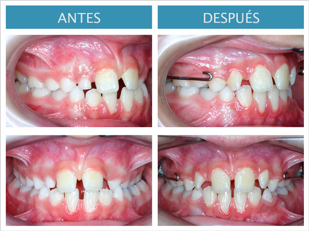 Caso ortodoncia infantil Ortom Madrid