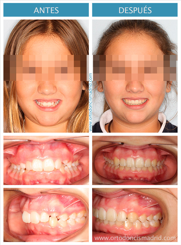 Sonrisa gingival corregida con ortodoncia